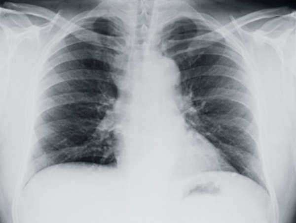 Mesotelioma Diagnostico